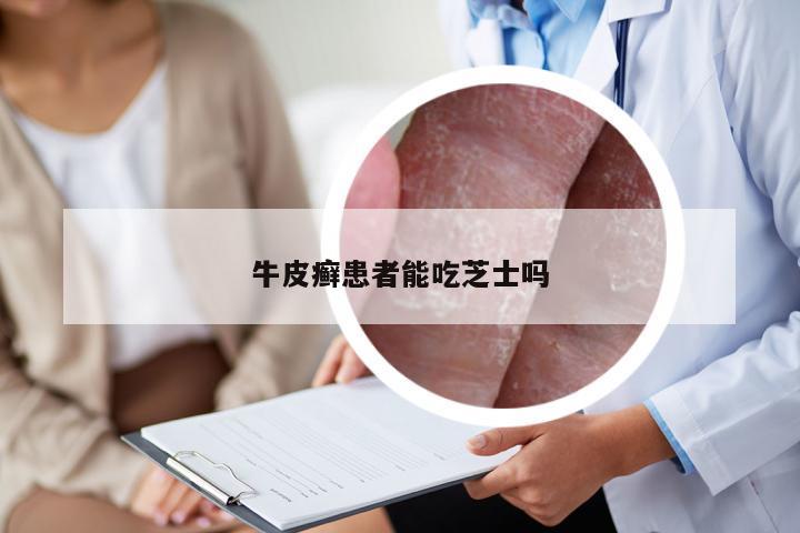 牛皮癣患者能吃芝士吗