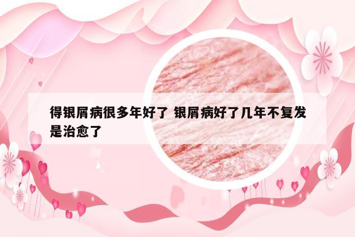 得银屑病很多年好了 银屑病好了几年不复发是治愈了