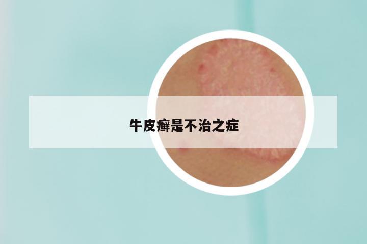 牛皮癣是不治之症