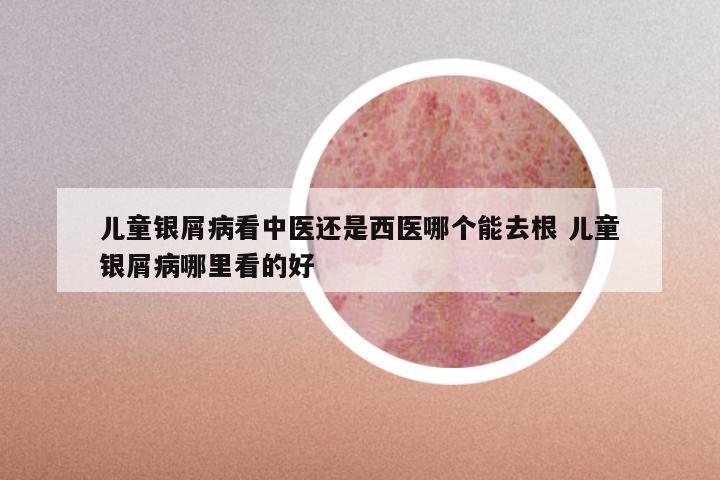 儿童银屑病看中医还是西医哪个能去根 儿童银屑病哪里看的好