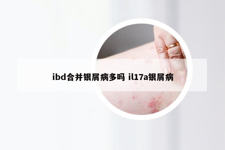 ibd合并银屑病多吗 il17a银屑病
