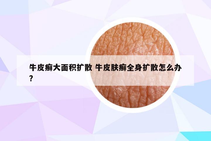 牛皮癣大面积扩散 牛皮肤癣全身扩散怎么办?