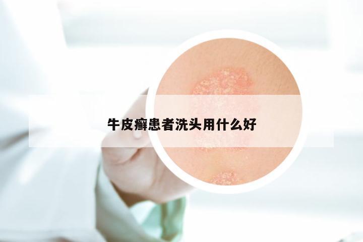 牛皮癣患者洗头用什么好