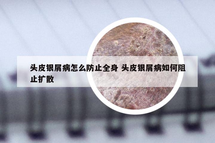 头皮银屑病怎么防止全身 头皮银屑病如何阻止扩散