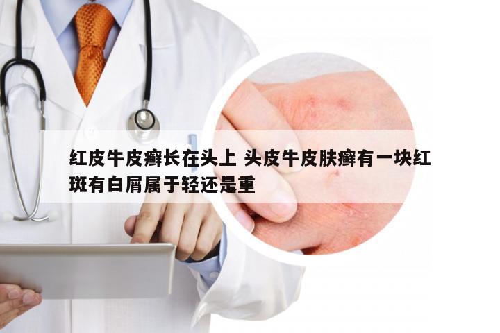 红皮牛皮癣长在头上 头皮牛皮肤癣有一块红斑有白屑属于轻还是重