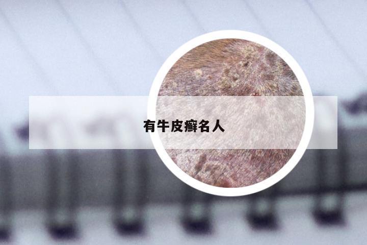 有牛皮癣名人