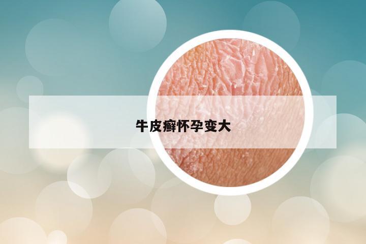 牛皮癣怀孕变大
