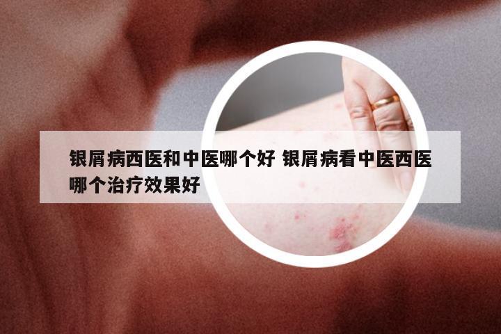 银屑病西医和中医哪个好 银屑病看中医西医哪个治疗效果好