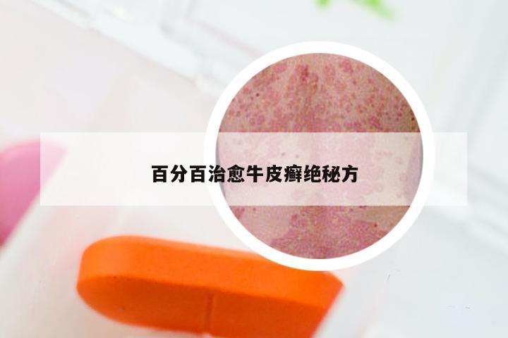 百分百治愈牛皮癣绝秘方
