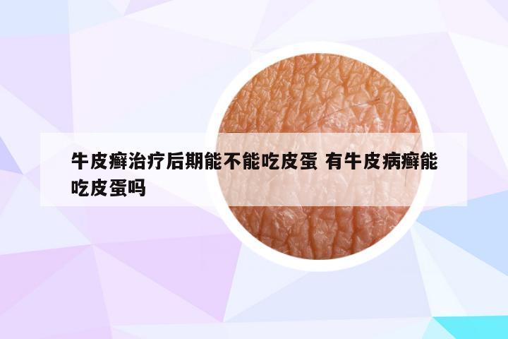 牛皮癣治疗后期能不能吃皮蛋 有牛皮病癣能吃皮蛋吗