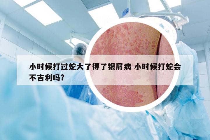 小时候打过蛇大了得了银屑病 小时候打蛇会不吉利吗?