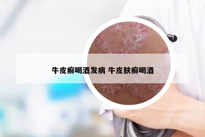 牛皮癣喝酒发病 牛皮肤癣喝酒