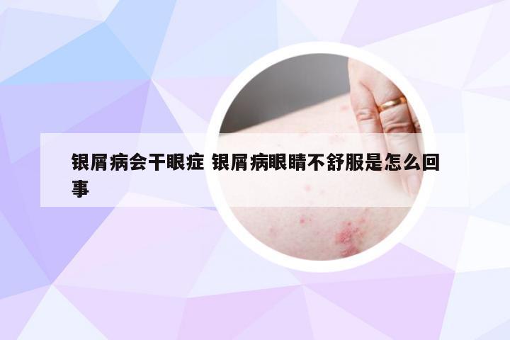 银屑病会干眼症 银屑病眼睛不舒服是怎么回事