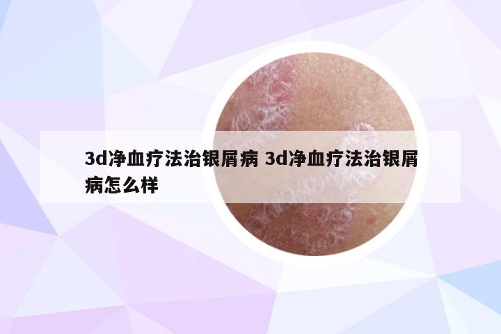 3d净血疗法治银屑病 3d净血疗法治银屑病怎么样