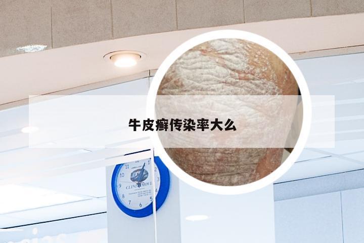 牛皮癣传染率大么