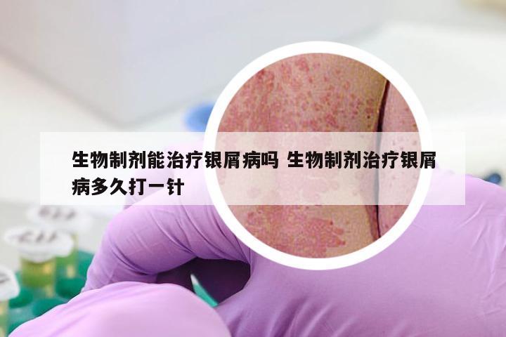 生物制剂能治疗银屑病吗 生物制剂治疗银屑病多久打一针