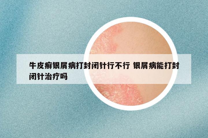 牛皮癣银屑病打封闭针行不行 银屑病能打封闭针治疗吗