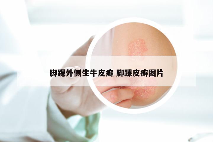 脚踝外侧生牛皮癣 脚踝皮癣图片