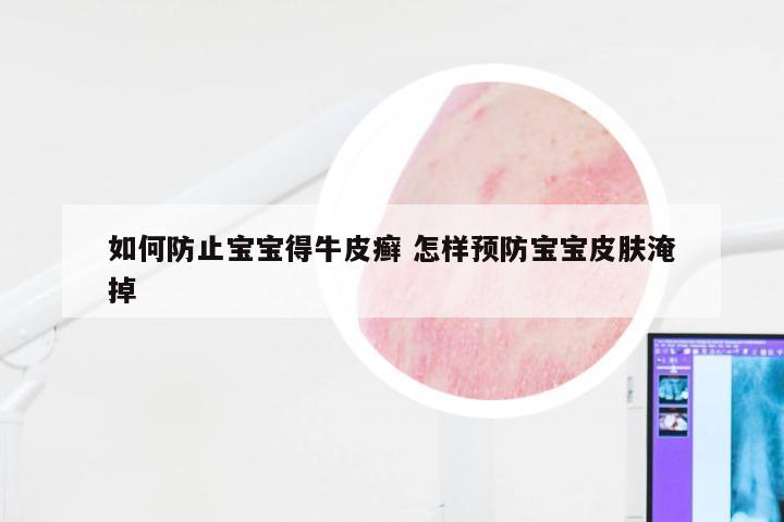 如何防止宝宝得牛皮癣 怎样预防宝宝皮肤淹掉