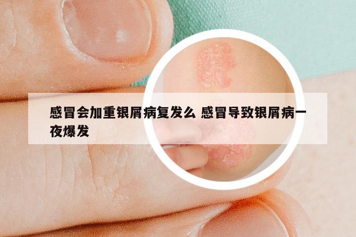 感冒会加重银屑病复发么 感冒导致银屑病一夜爆发