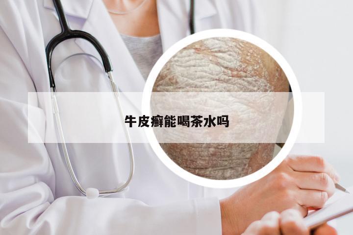 牛皮癣能喝茶水吗