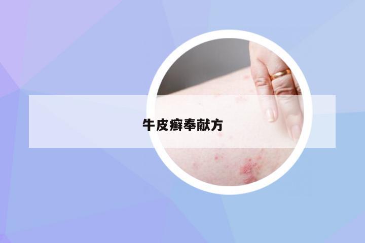 牛皮癣奉献方