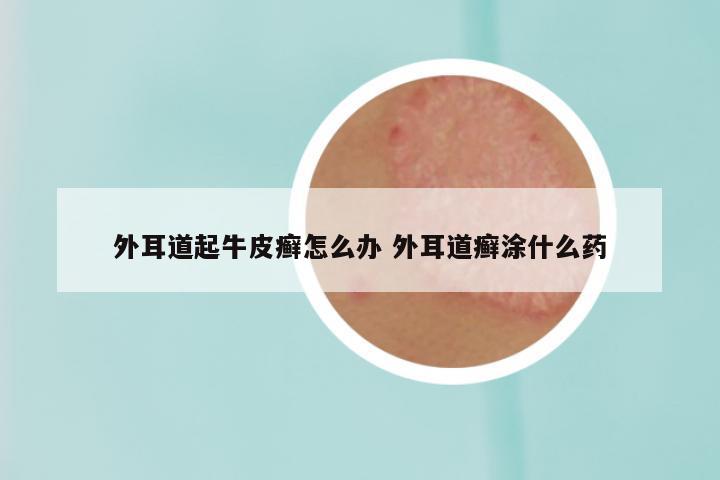 外耳道起牛皮癣怎么办 外耳道癣涂什么药