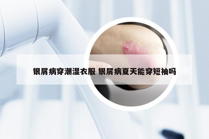 银屑病穿潮湿衣服 银屑病夏天能穿短袖吗