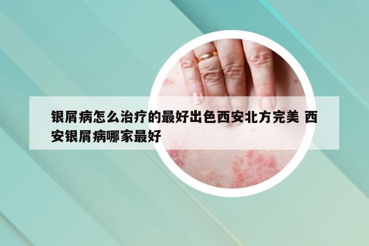 银屑病怎么治疗的最好出色西安北方完美 西安银屑病哪家最好