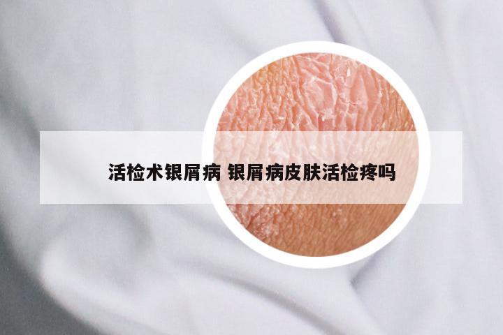 活检术银屑病 银屑病皮肤活检疼吗