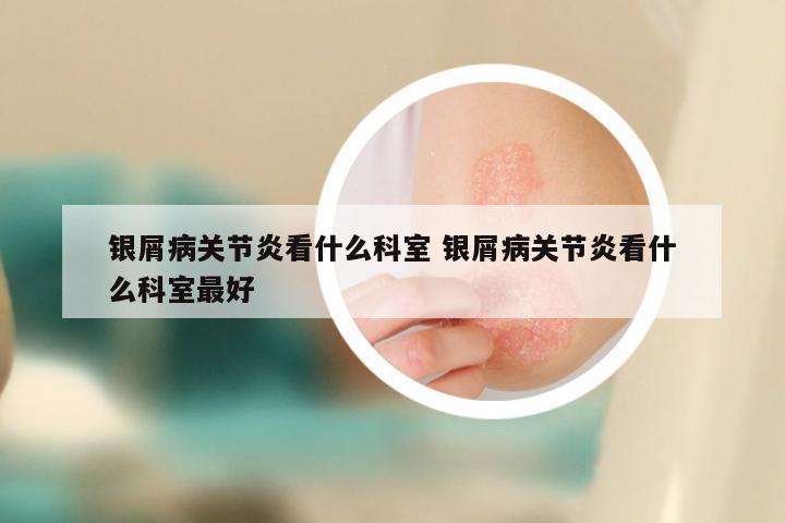 银屑病关节炎看什么科室 银屑病关节炎看什么科室最好