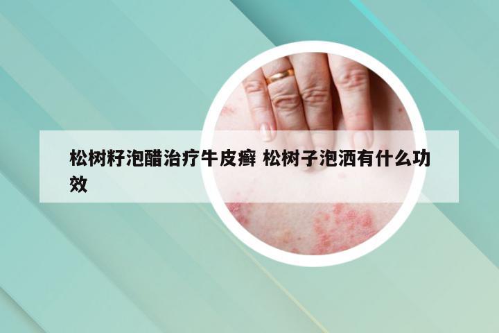 松树籽泡醋治疗牛皮癣 松树子泡洒有什么功效