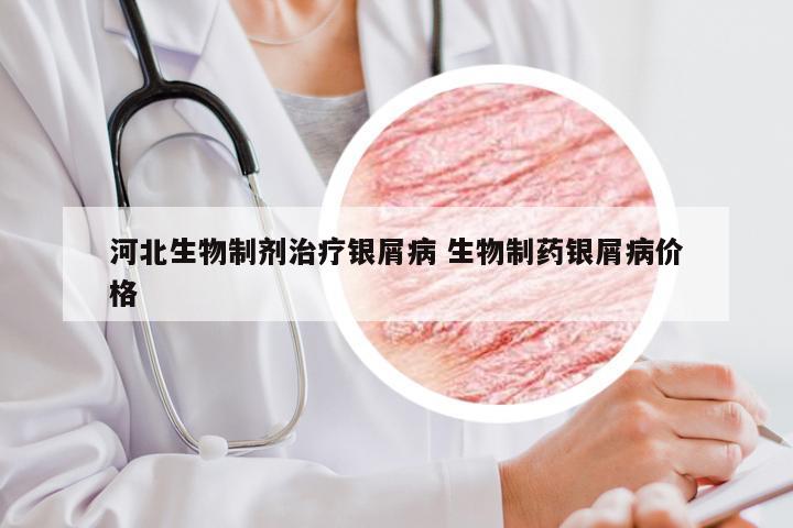 河北生物制剂治疗银屑病 生物制药银屑病价格