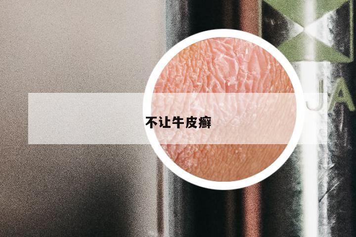 不让牛皮癣