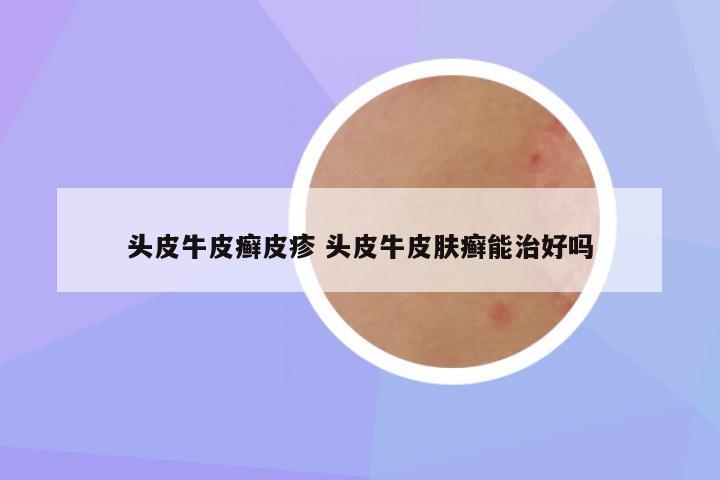 头皮牛皮癣皮疹 头皮牛皮肤癣能治好吗