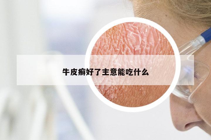 牛皮癣好了主意能吃什么