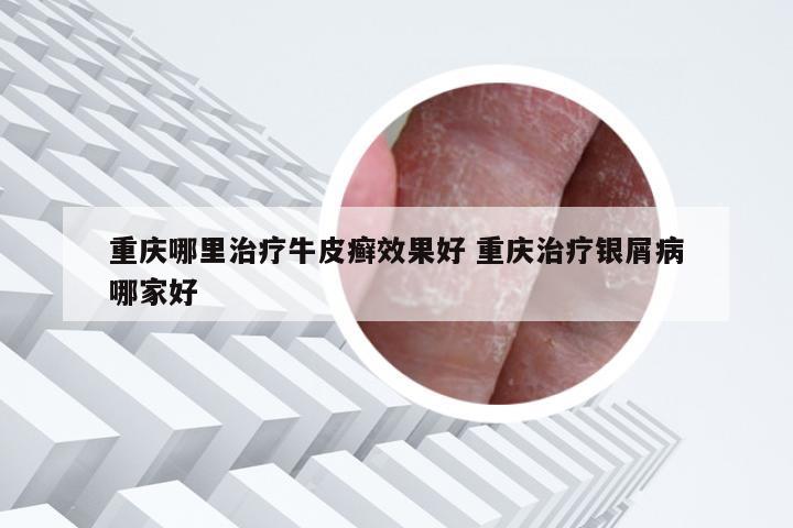 重庆哪里治疗牛皮癣效果好 重庆治疗银屑病哪家好