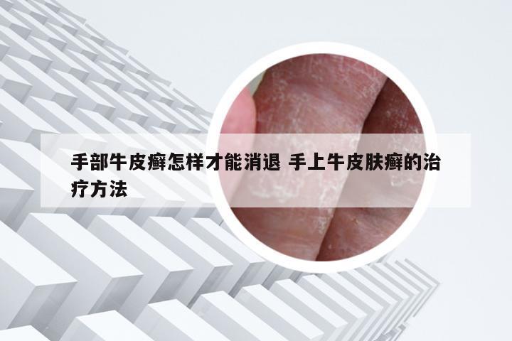 手部牛皮癣怎样才能消退 手上牛皮肤癣的治疗方法
