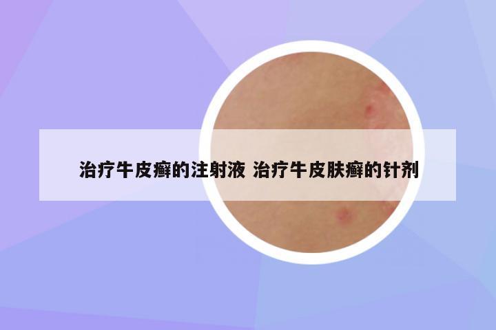 治疗牛皮癣的注射液 治疗牛皮肤癣的针剂