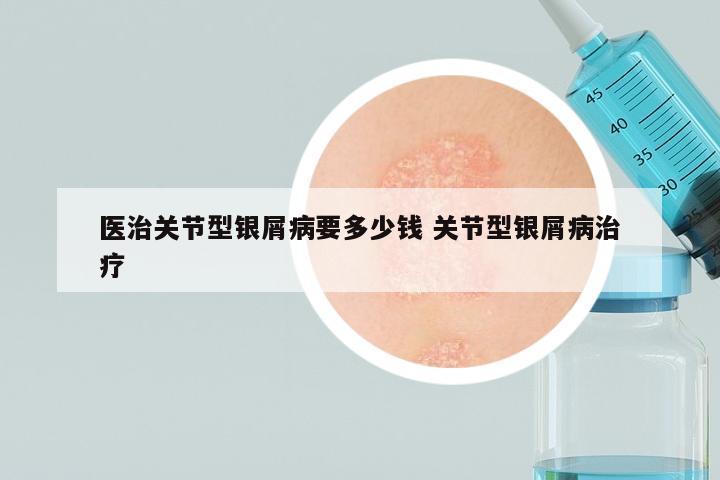 医治关节型银屑病要多少钱 关节型银屑病治疗