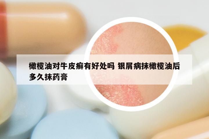 橄榄油对牛皮癣有好处吗 银屑病抹橄榄油后多久抹药膏