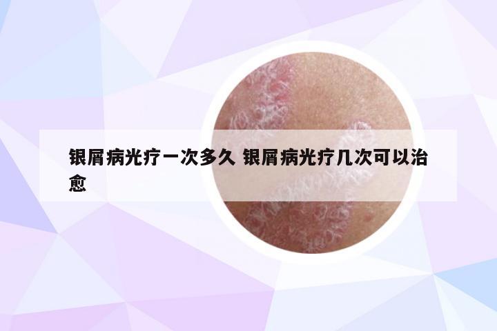 银屑病光疗一次多久 银屑病光疗几次可以治愈