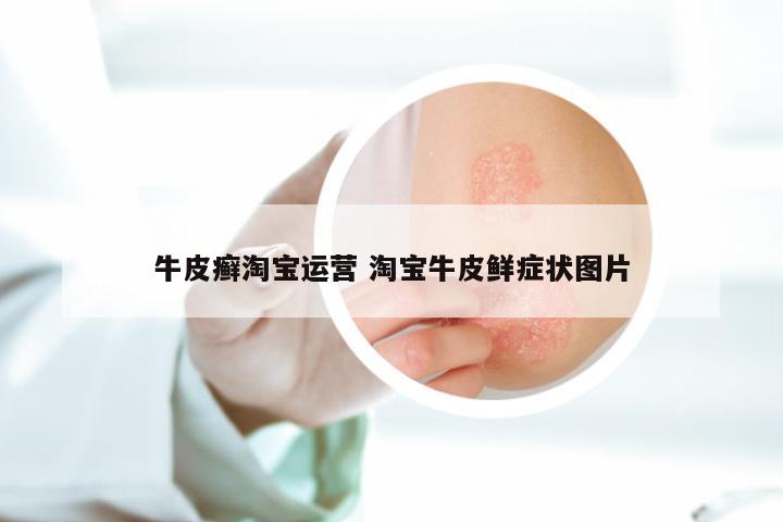 牛皮癣淘宝运营 淘宝牛皮鲜症状图片