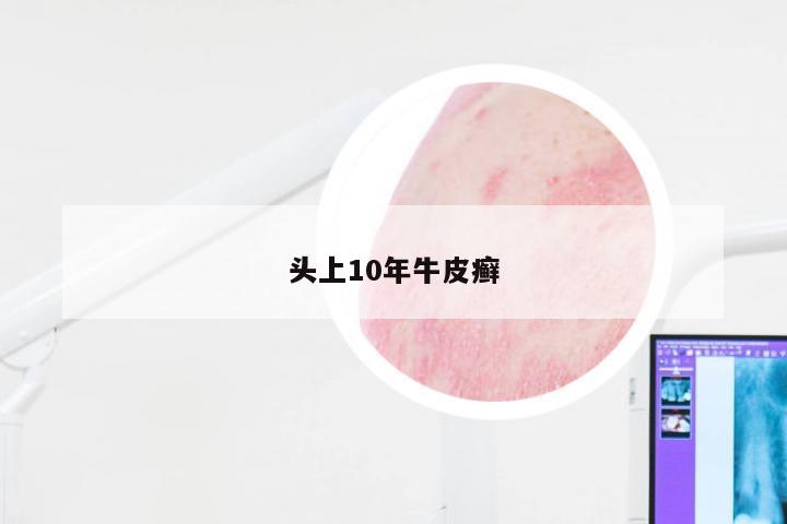 头上10年牛皮癣
