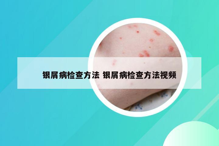 银屑病检查方法 银屑病检查方法视频