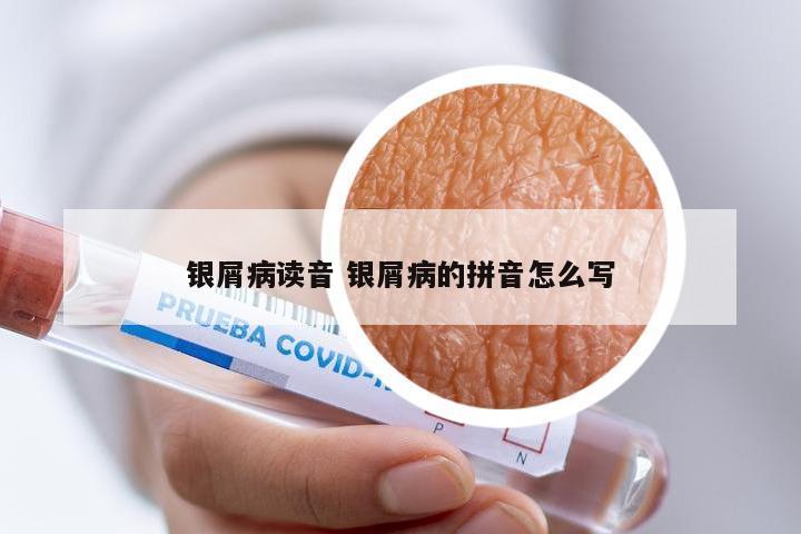银屑病读音 银屑病的拼音怎么写
