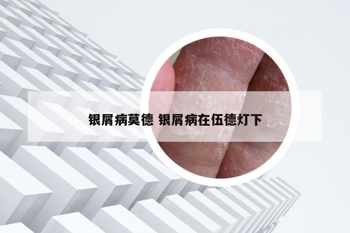 银屑病莫德 银屑病在伍德灯下