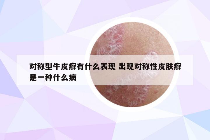 对称型牛皮癣有什么表现 出现对称性皮肤癣是一种什么病