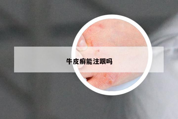 牛皮癣能注跟吗