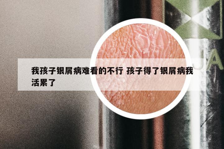 我孩子银屑病难看的不行 孩子得了银屑病我活累了